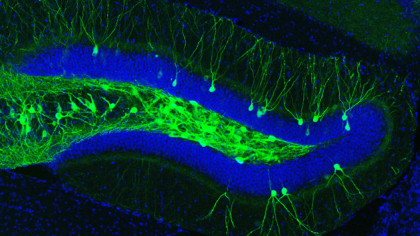 Alzheimer: sviluppata tecnica per recuperare ricordi perduti